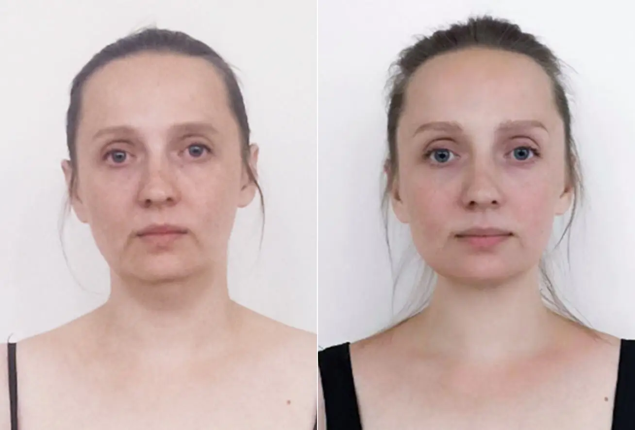 R&eacute;sultats yoga du visage avant apr&egrave;s 2 mois de travail biom&eacute;canique des rides