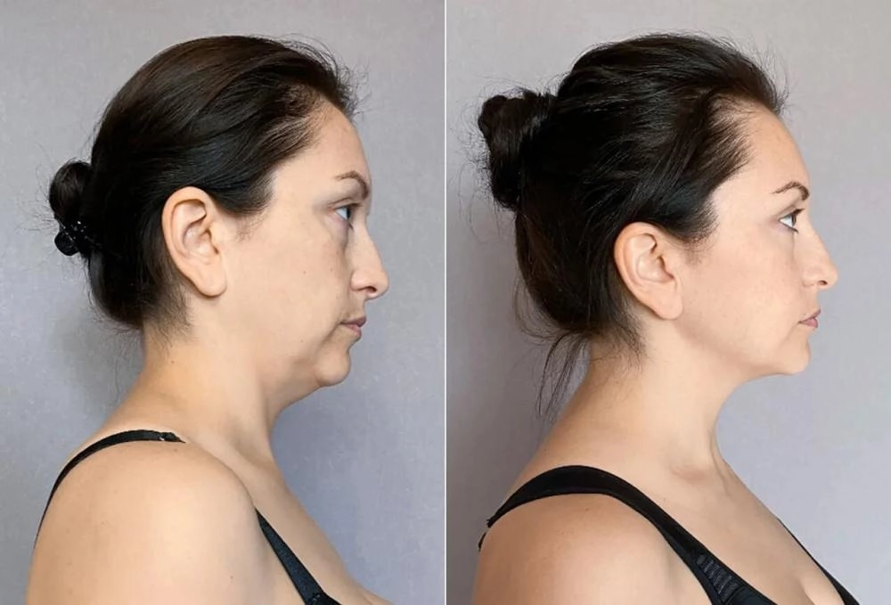 R&eacute;sultats yoga du visage biom&eacute;canique avant apr&egrave;s technique espandory