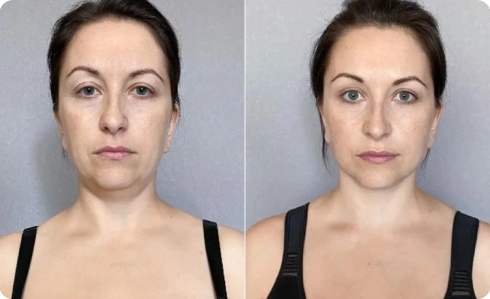 R&eacute;sultats yoga du visage avant apr&egrave;s technique espandory