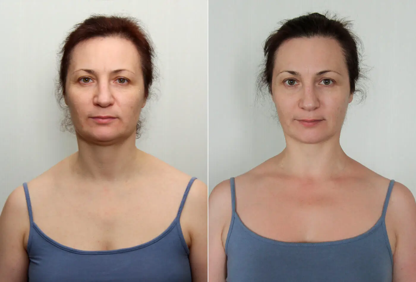 yoga du visage avant après résultats 3 mois