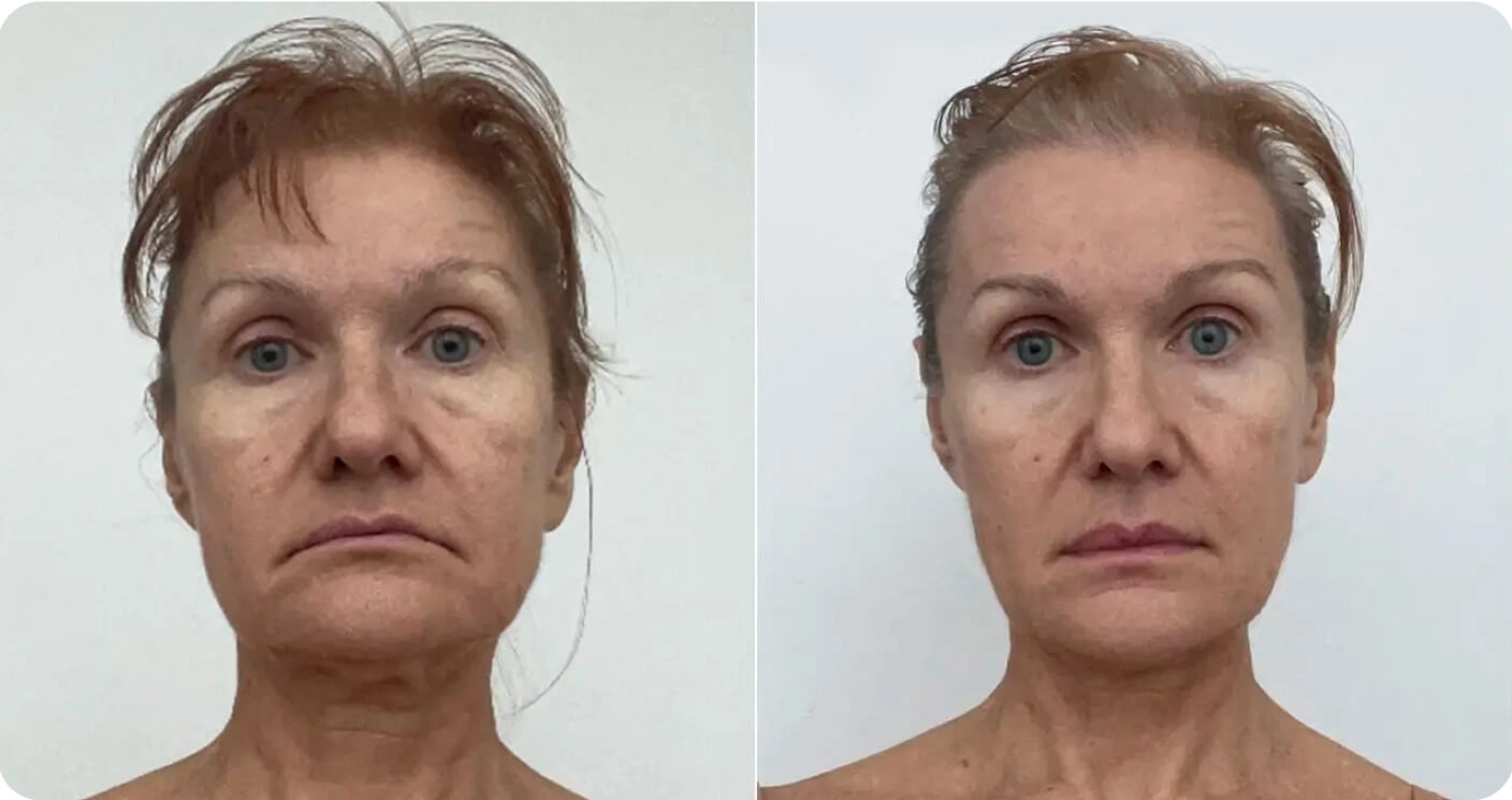 résultat avant après yoga du visage rides autour de la bouche