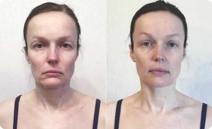 résultat avant après yoga du visage biomécanique rides autour de la bouche