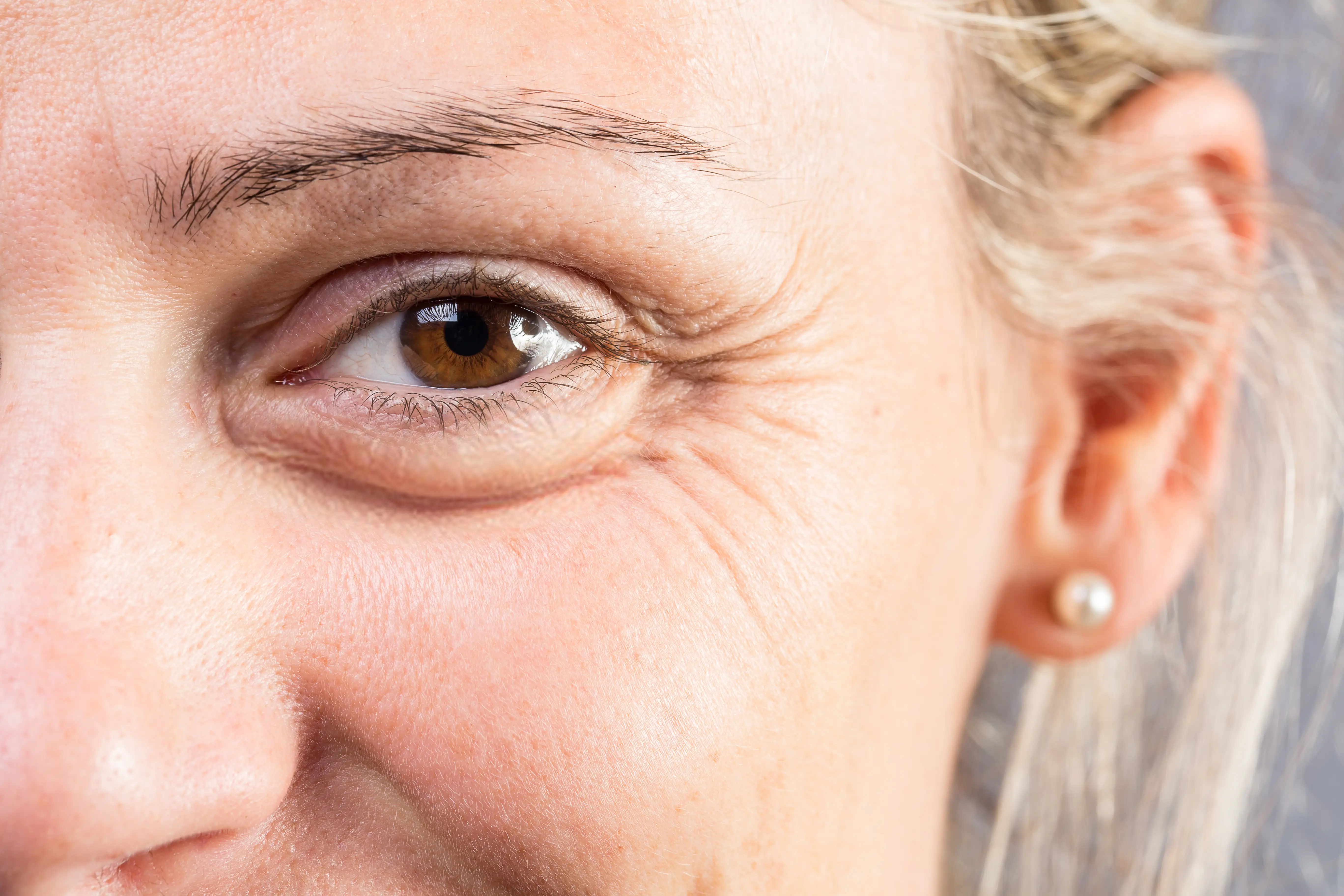 rides autour des yeux 