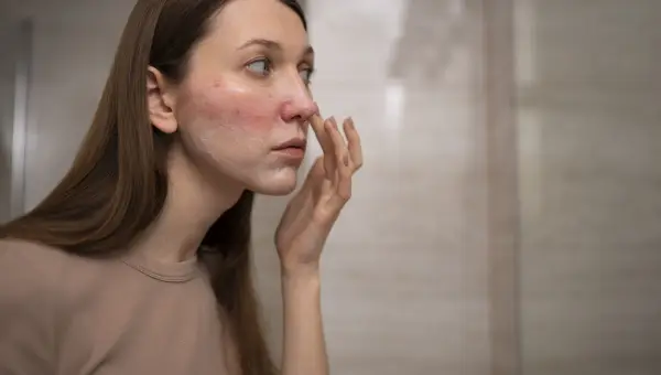 &oelig;d&egrave;mes et br&ucirc;lures du visage apr&egrave;s lifting RF