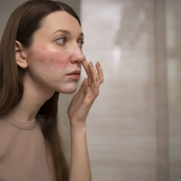&oelig;d&egrave;mes et br&ucirc;lures du visage apr&egrave;s lifting RF