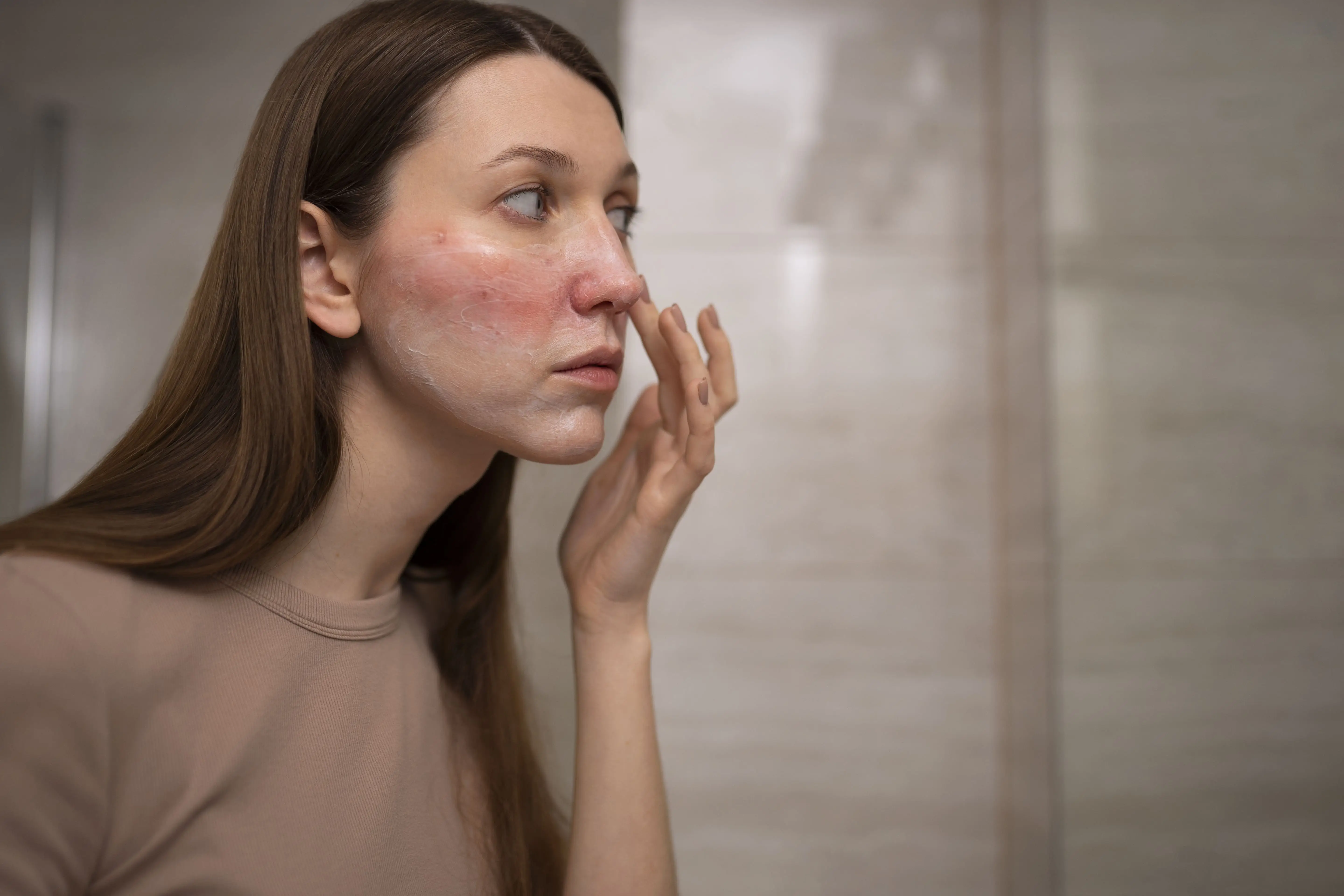 &oelig;d&egrave;mes et br&ucirc;lures du visage apr&egrave;s lifting RF